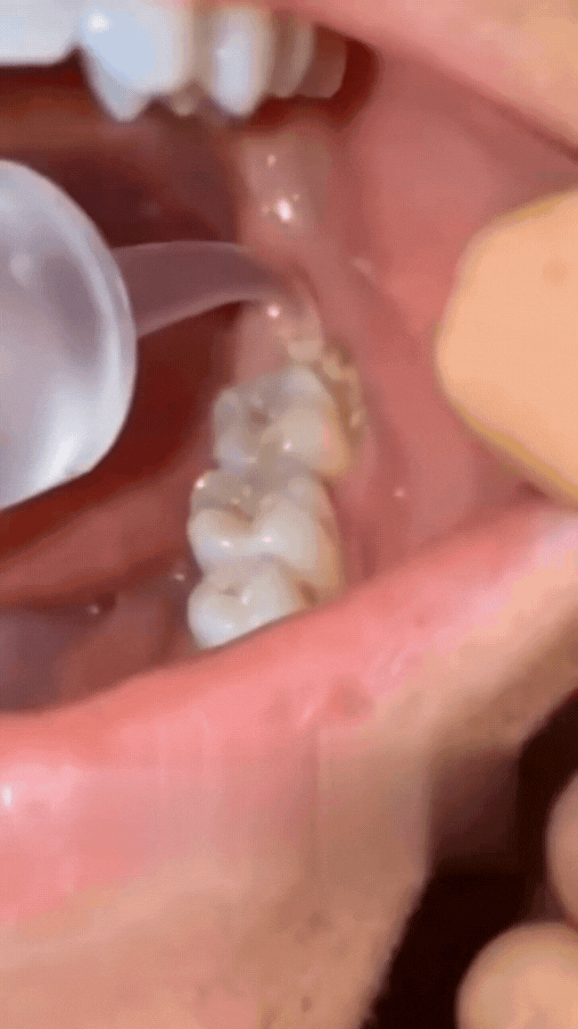 TikTok-doctorsooj-Can_you_remove_tonsil_stones_with_a_water_flosser_health_gross_to..._7437601592137862433_.mp4_2.gif
